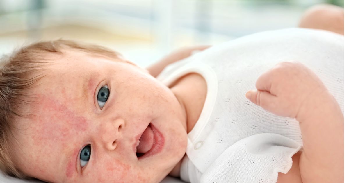 atopicky-ekzem-deti (1)